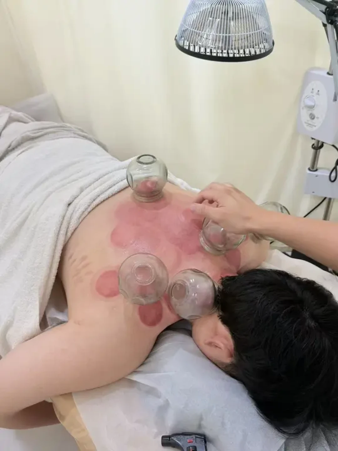 拔罐印越深,毒素越多?先搞清楚背上那圈印子,再决定办不办卡