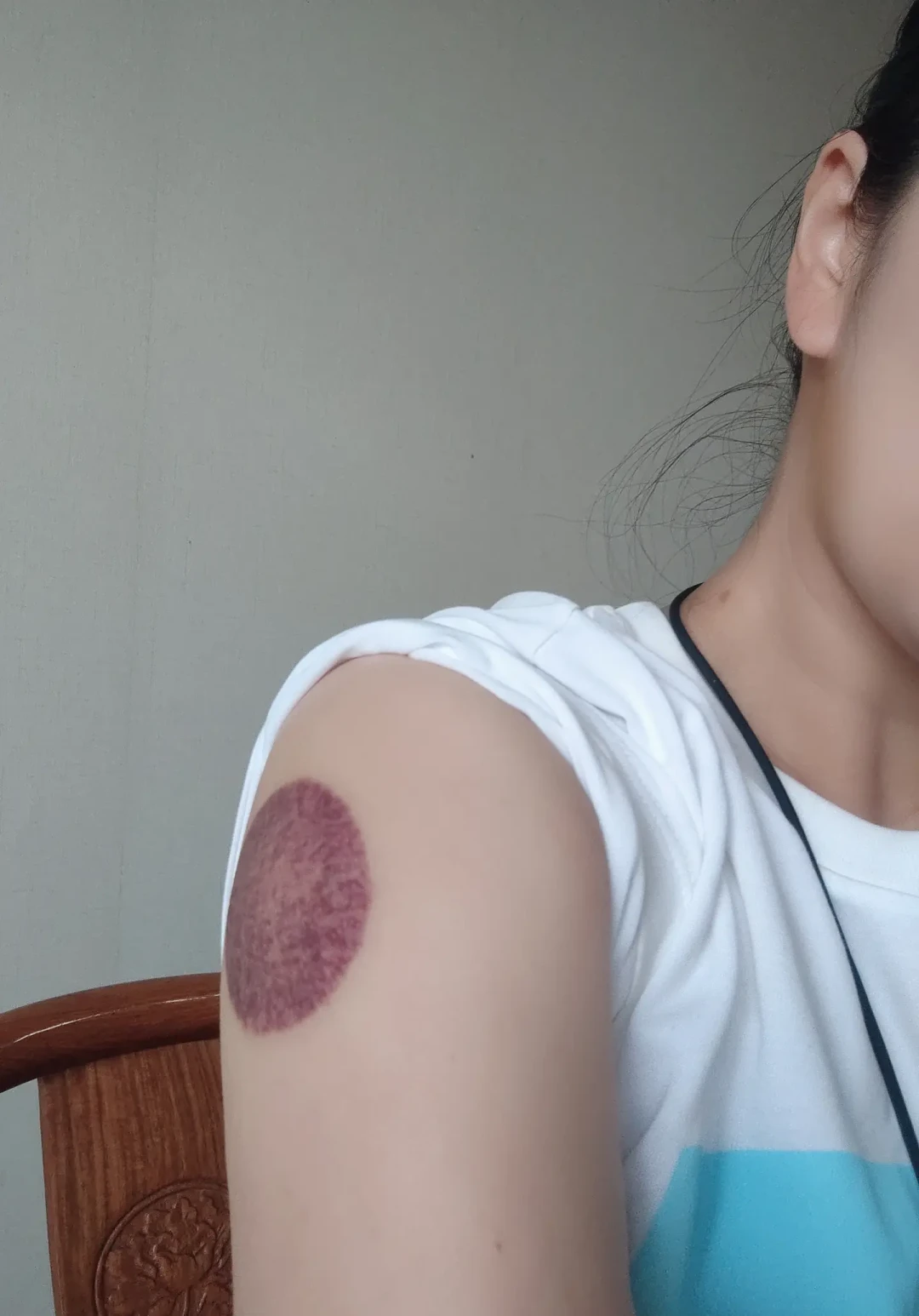 拔罐印越深,毒素越多?先搞清楚背上那圈印子,再决定办不办卡