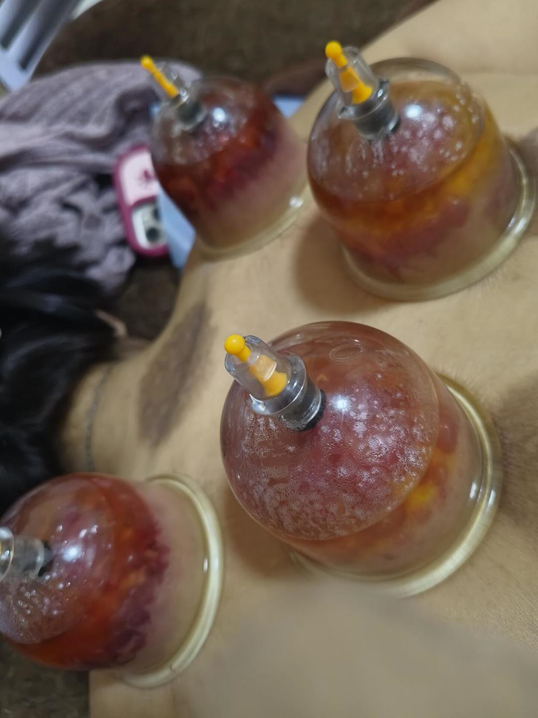 明天出伏,还撞上处暑:灸完40天三伏灸的人,接着灸还是停?先看出伏换挡自查表