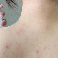 女生前胸后背长痘用什么沐浴露？4款热门沐浴露实测