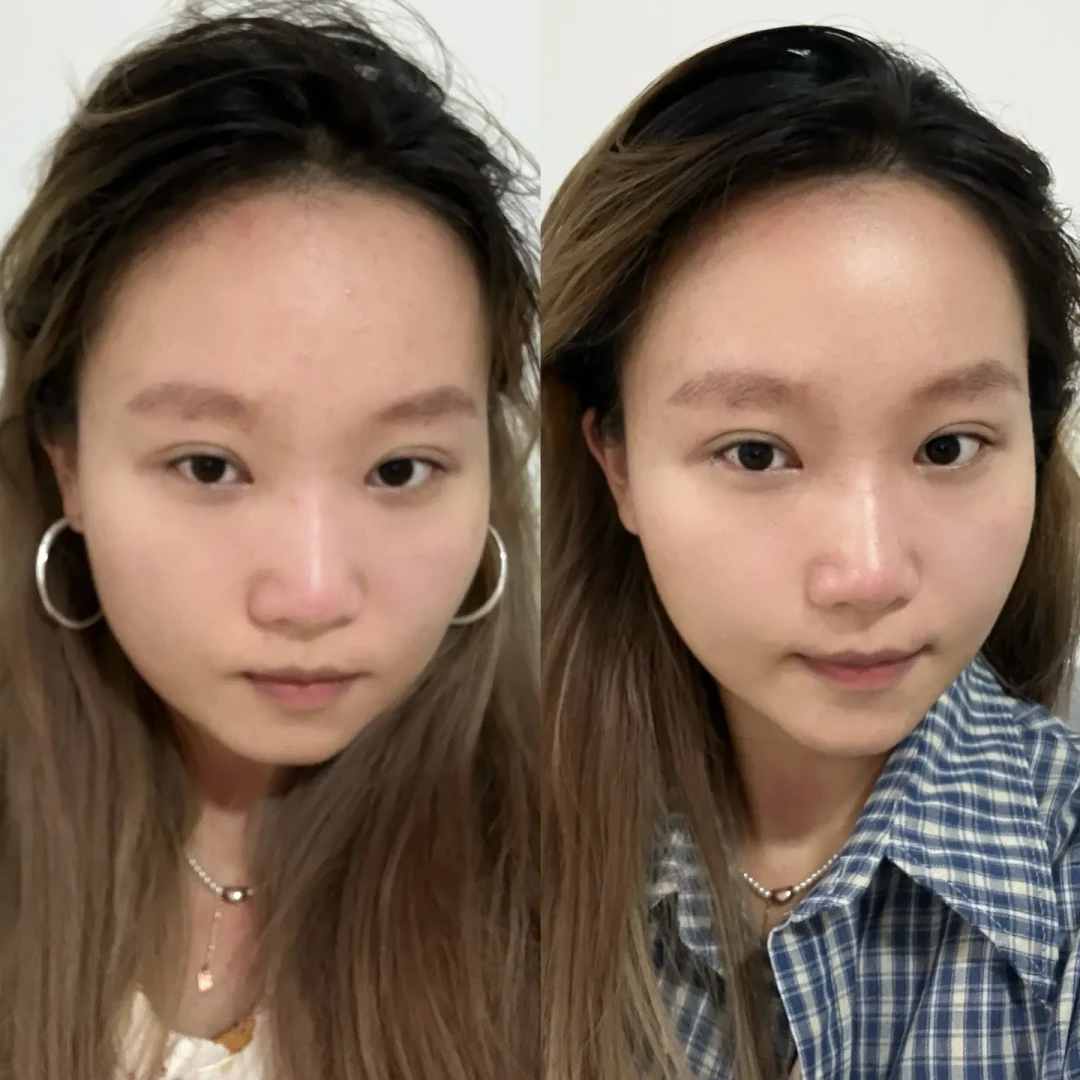射频美容仪下架了,“即刻提拉”却全网刷屏:那阵紧致感,大多是消水肿,不是胶原