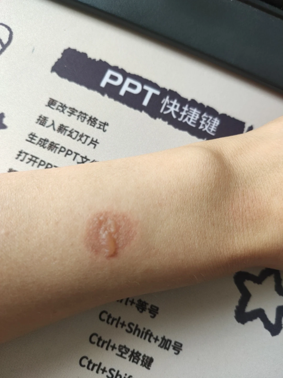 今天出伏,三伏贴“收官”:加强贴该不该贴、起泡和贴印怎么办,看完再决定