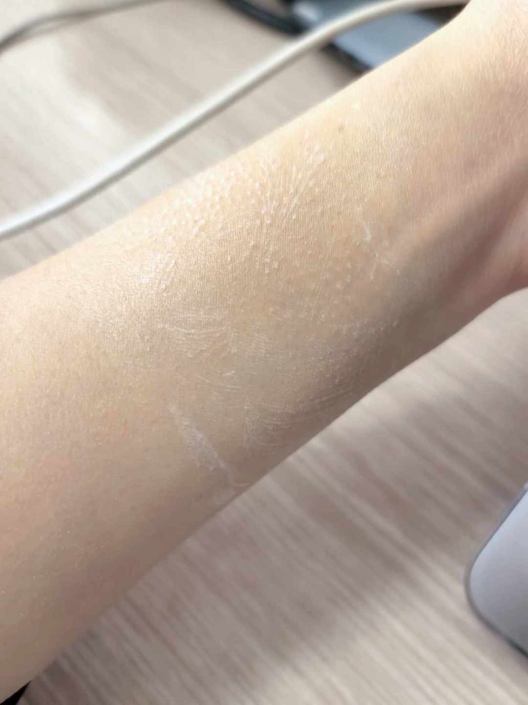 戴 Apple Watch 手腕痒？别急着换表带：对完 20 多条全网过敏吐槽，原因基本就 3 种