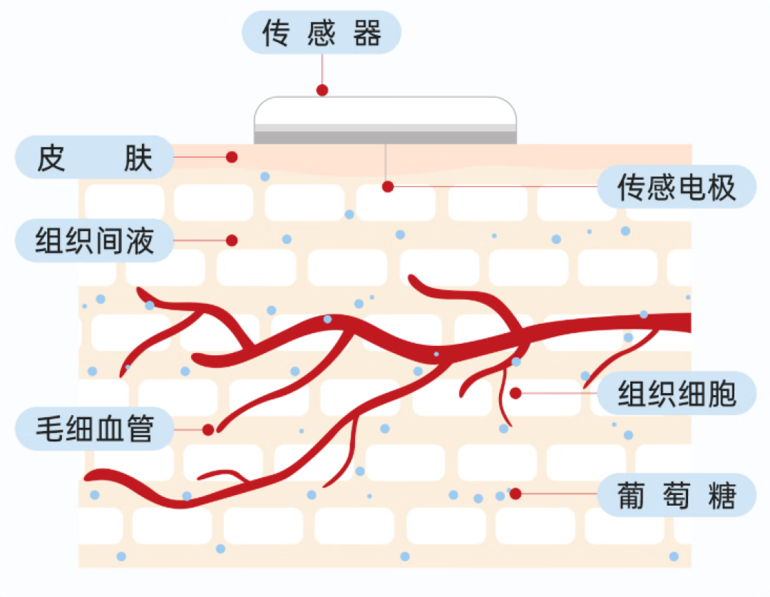 动态血糖仪都贴到健康人胳膊上了:一片80-400元,掏钱前先把医院这30元的账算清