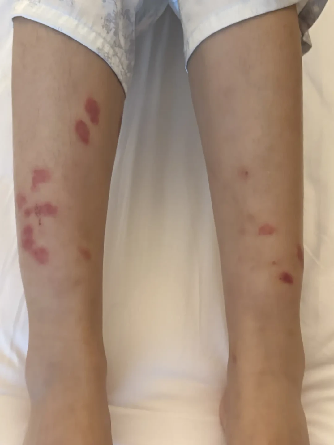 花2014元在欢朋住5晚，被咬出虫咬性皮炎，酒店只肯赔30元：翻完这个案例，我整理出了酒店虫咬维权清单