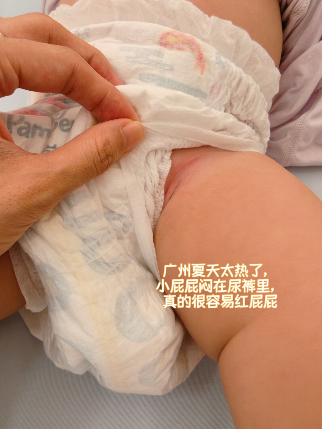 厚涂维蕾德也压不住红屁屁？先分清4种红屁屁，再说换哪支膏、什么时候去医院