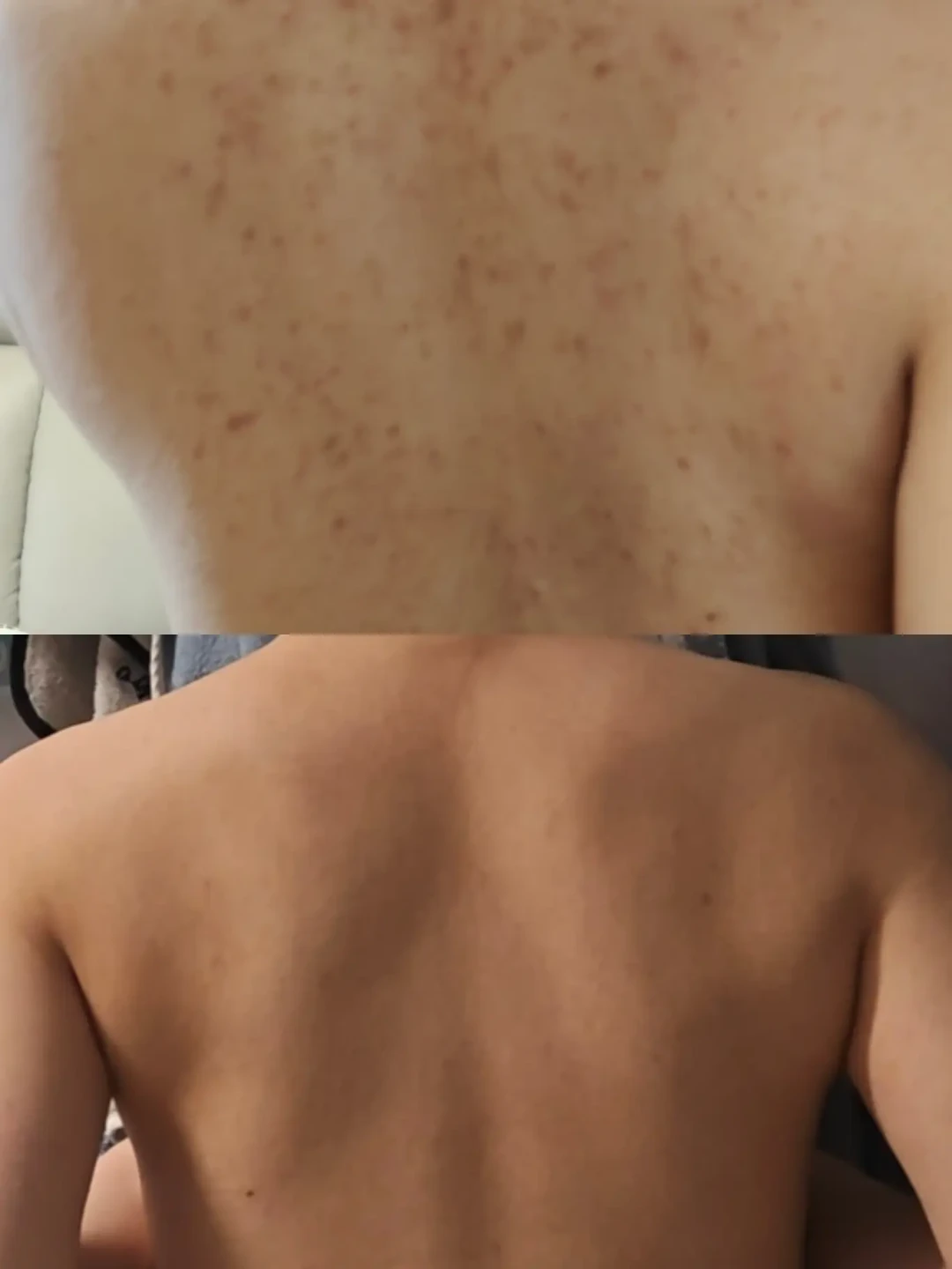 你后背上的痘可能压根不是「痘」:先分清痤疮、细菌、真菌,再决定花3块买硫磺皂还是30块买二硫化硒