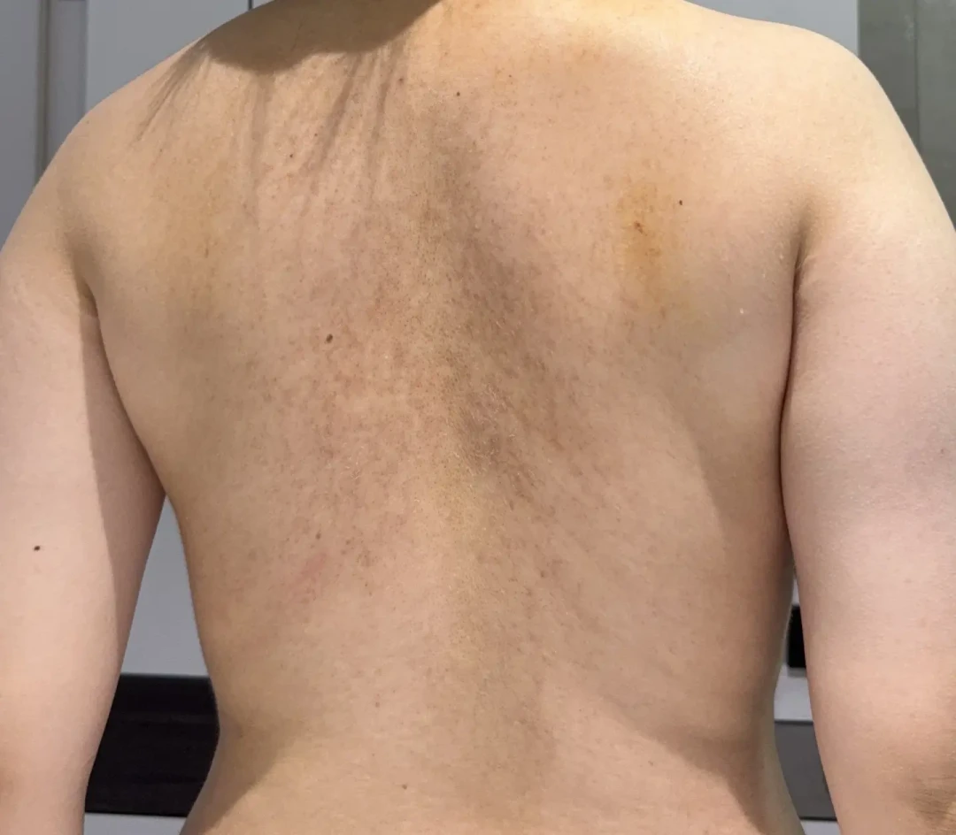 你后背上的痘可能压根不是「痘」:先分清痤疮、细菌、真菌,再决定花3块买硫磺皂还是30块买二硫化硒
