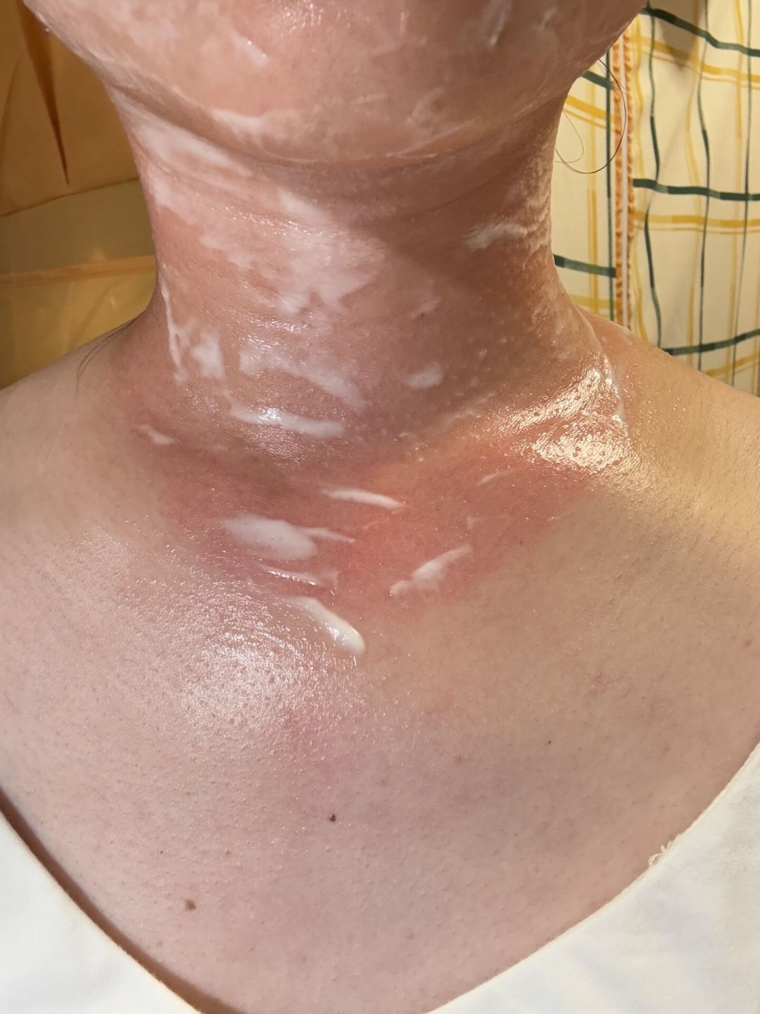 晒后72小时是止损窗口,不是美白倒计时:先降温、再修护、最后才轮到美白