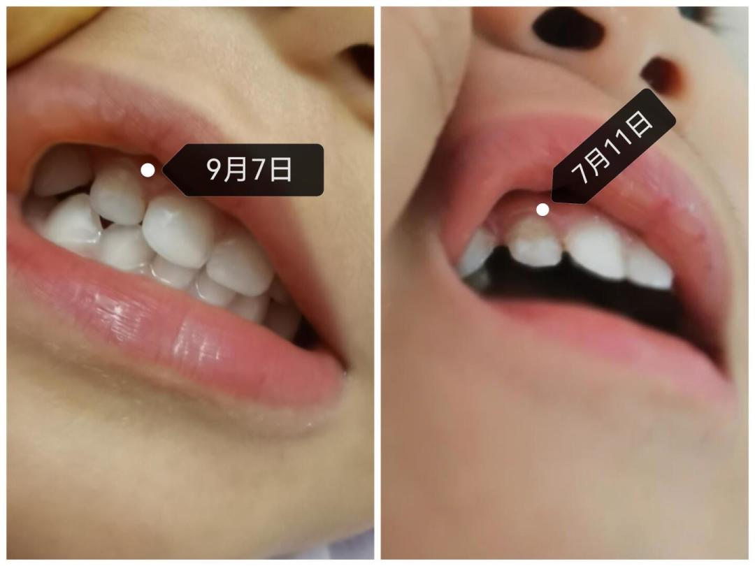 戴牙套两年,牙齐了但多了几块白斑?防脱矿真正值得买的,就这三档