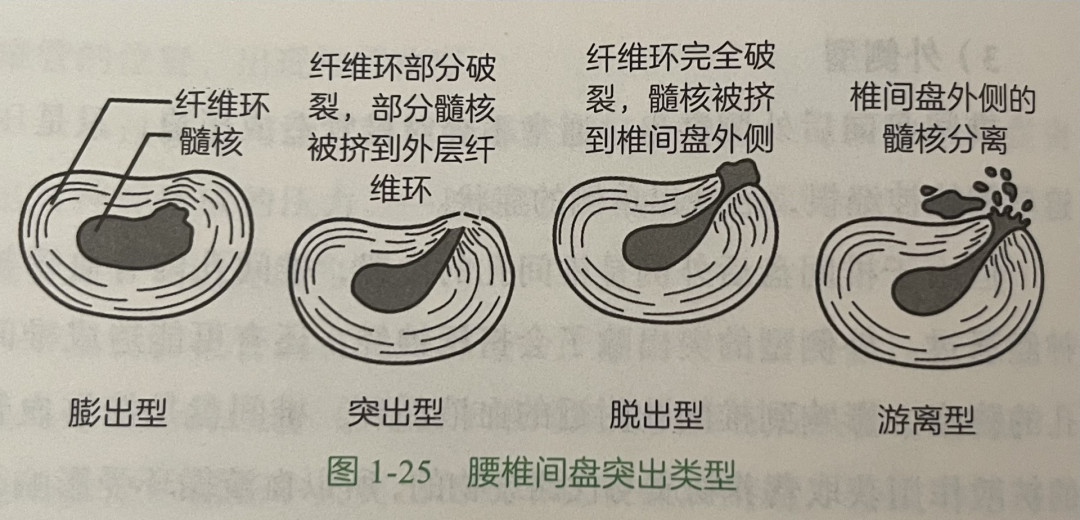 腰突能被正骨“按回去”吗？翻了全网40多条真实体验：这3种情况千万别去