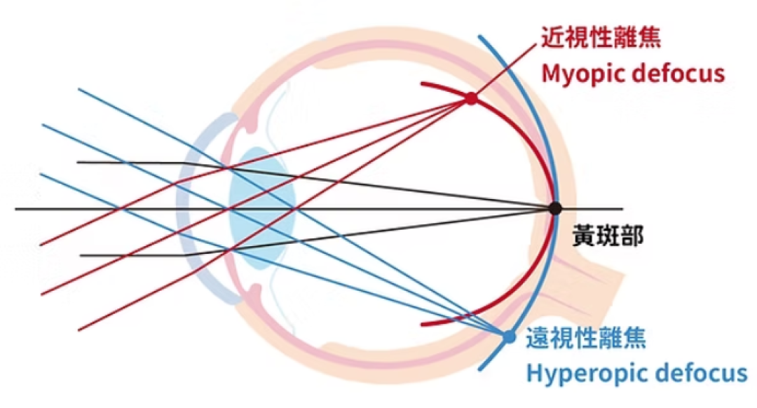 医院先推OK镜、眼镜店先推蔡司离焦镜:这笔三年的账,两边都不会主动告诉你
