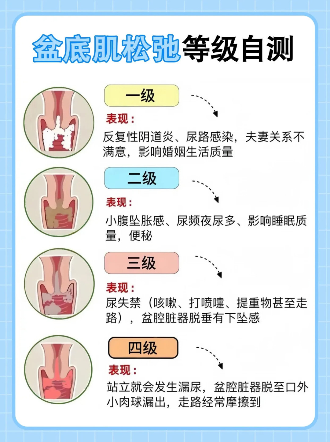 拿到盆底肌评估报告别急着练凯格尔:约20%-30%的产后问题是“紧”不是“松”