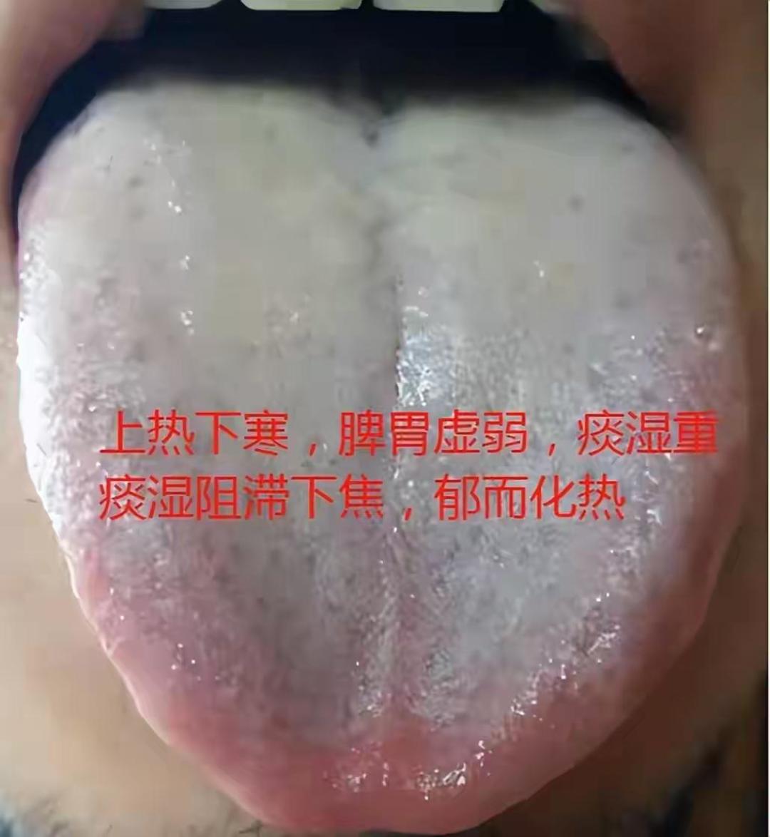 手脚冰凉就是寒证,长痘就是热证?八纲辨证自学者,大多栽在这一步