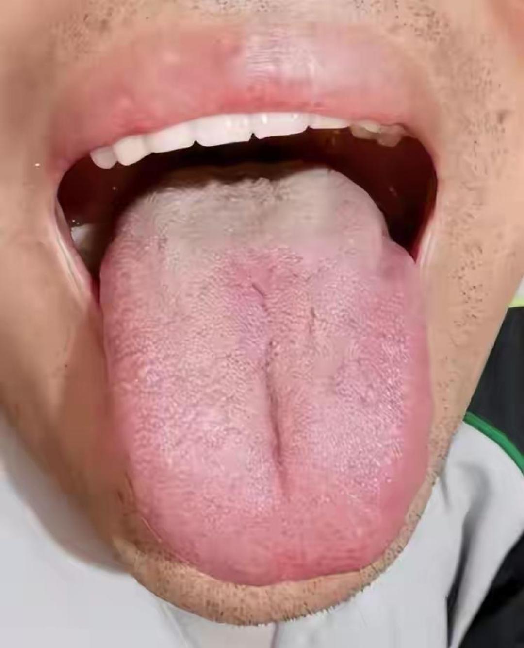 手脚冰凉就是寒证,长痘就是热证?八纲辨证自学者,大多栽在这一步