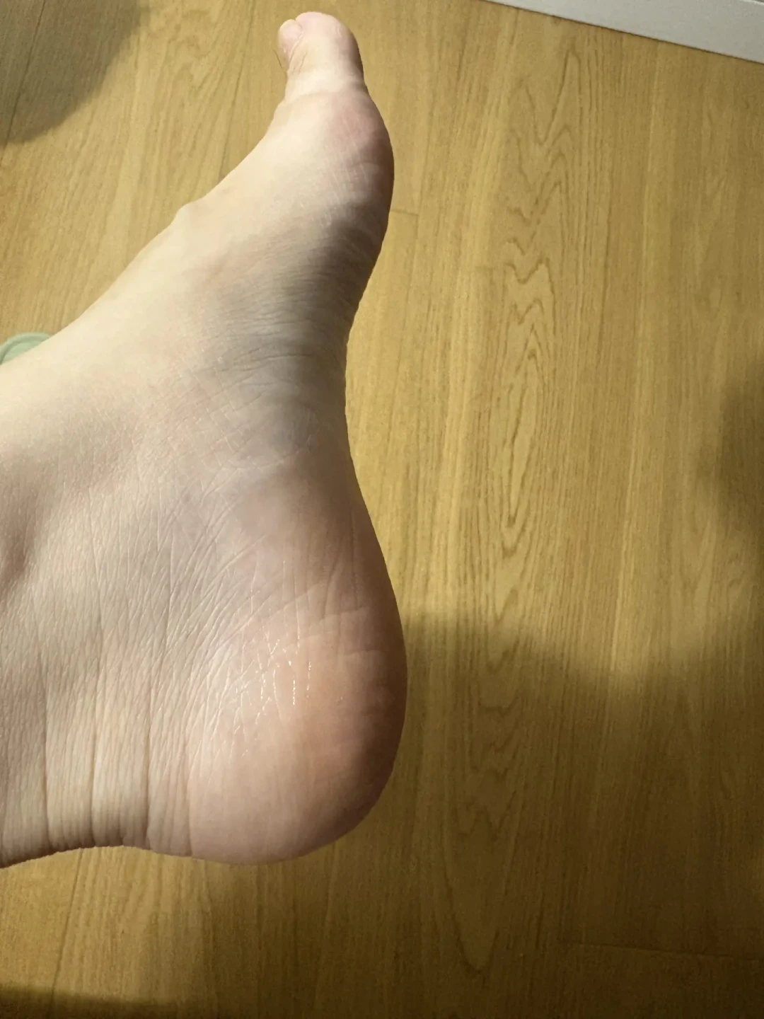 穿了个夏天洞洞鞋，脚后跟变“铁皮”：买足膜之前，先分清是“干”还是“脚气”