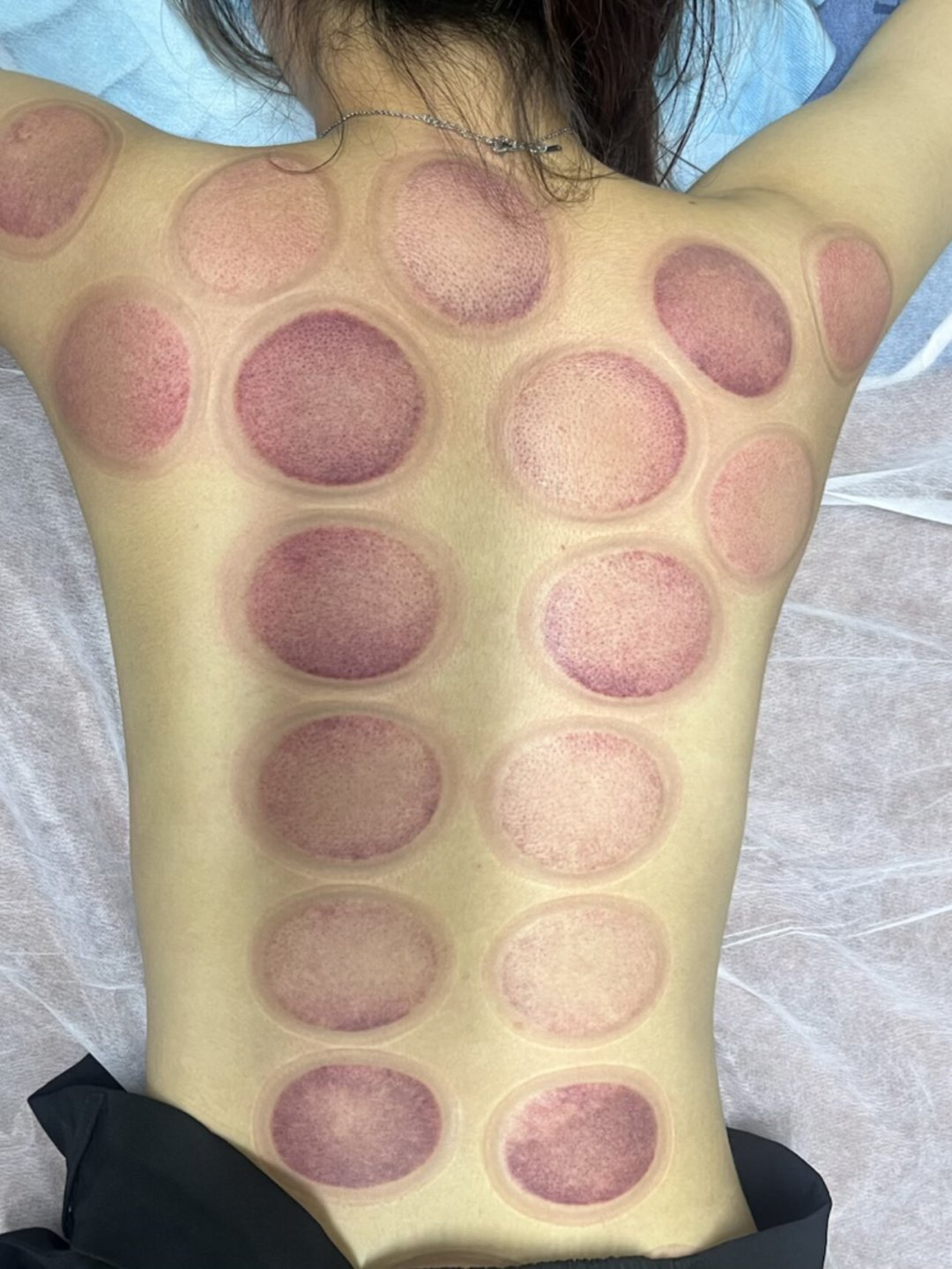 一边是烧伤获赔20万余元，一边是年轻人还在排队拔罐：拔罐到底有没有用，值不值得花钱？