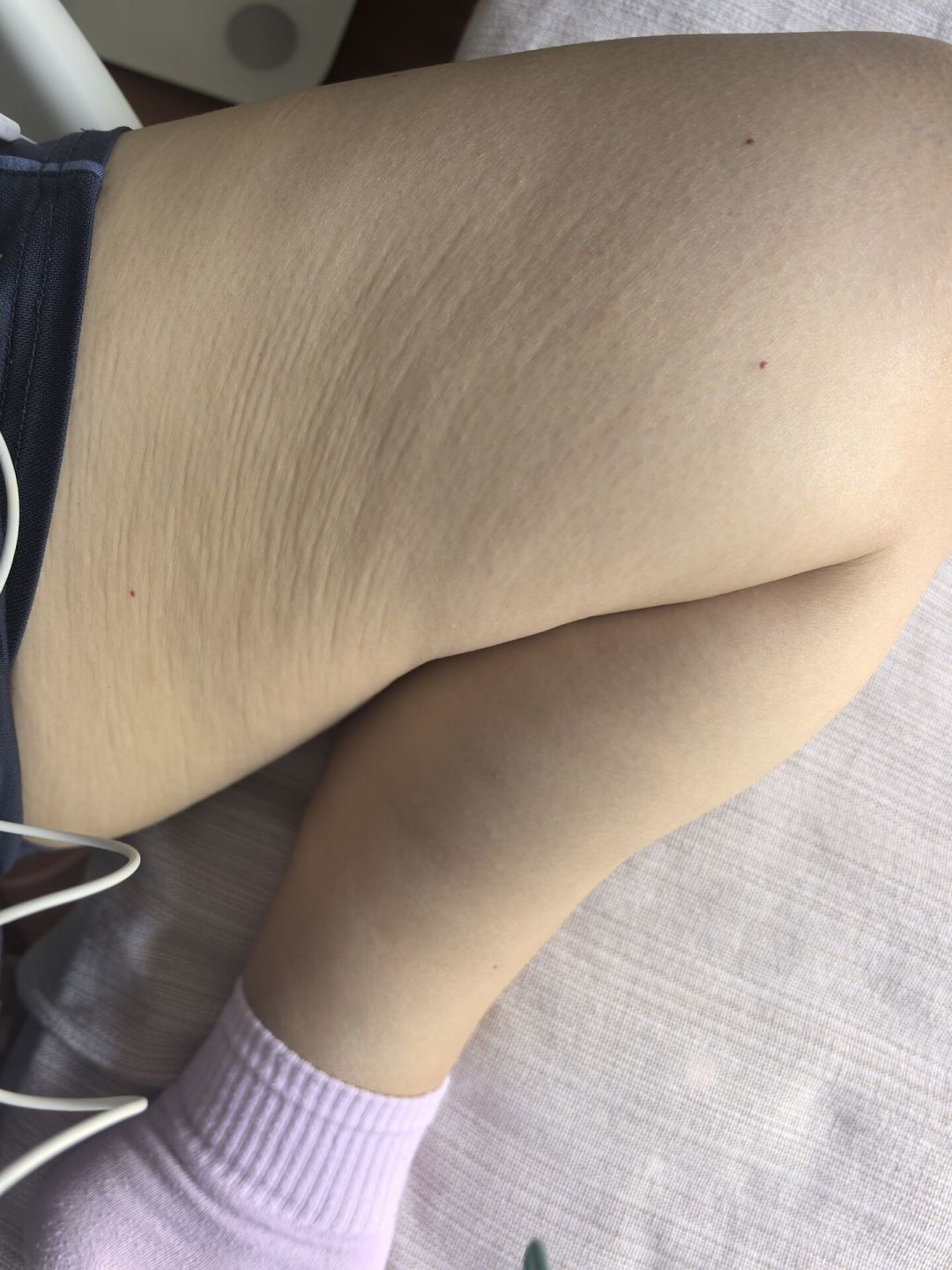 体重下来了,脸垮了、肚皮松了:减肥后的这笔“紧致账单”该怎么花