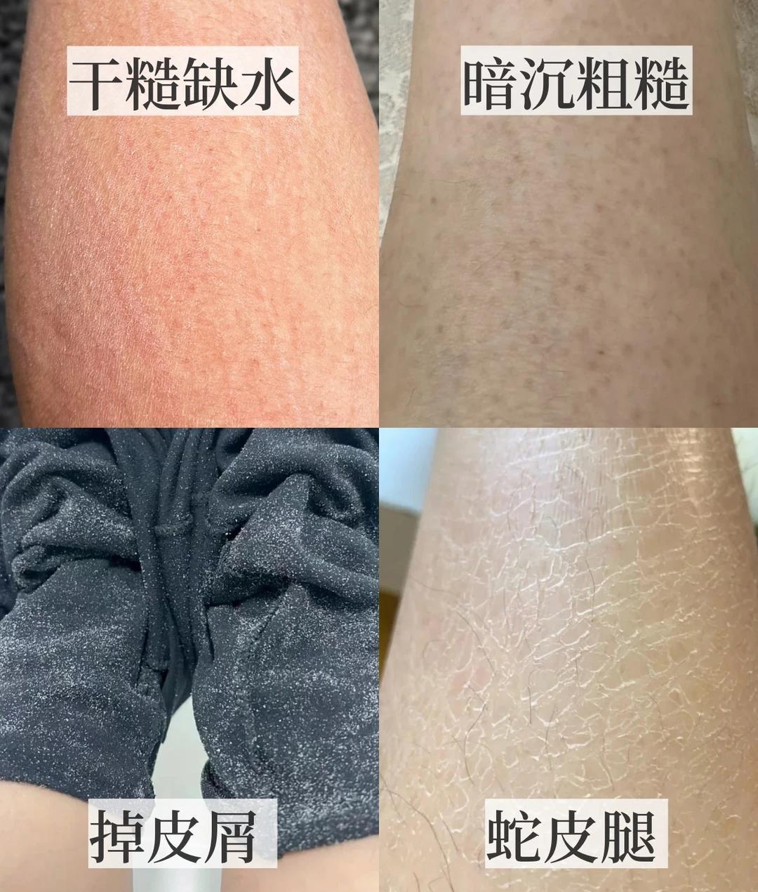 一运动就浑身痒?先别下单身体乳:3个问题分清干痒、汗痒和湿疹,再决定花20块保湿还是去医院