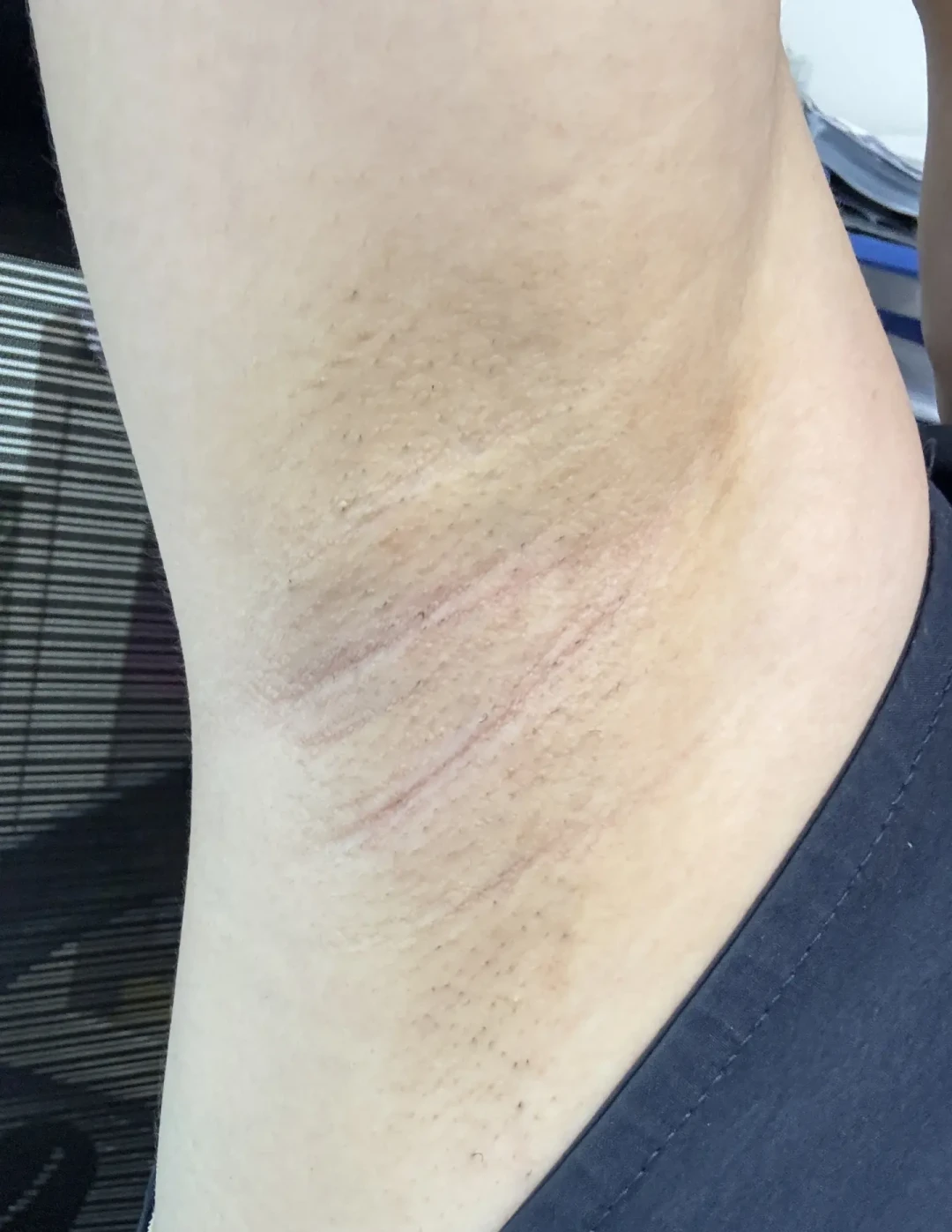 男生想脱毛,先看这条从十几元到3880元的真实价格线:280脱胡子引流坑、