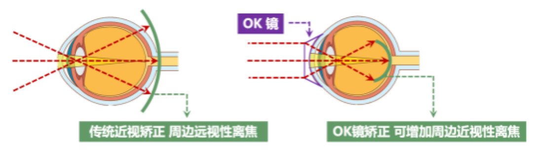 近视防控清单花了三万，医生说一半白花：还有两天开学，带娃复查前先看清钱该花在哪