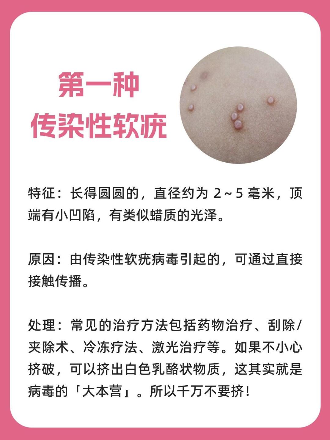 女孩游泳后长20多个疣上热搜:池水不背锅,更衣室才是高危区,识别和避坑一次讲清