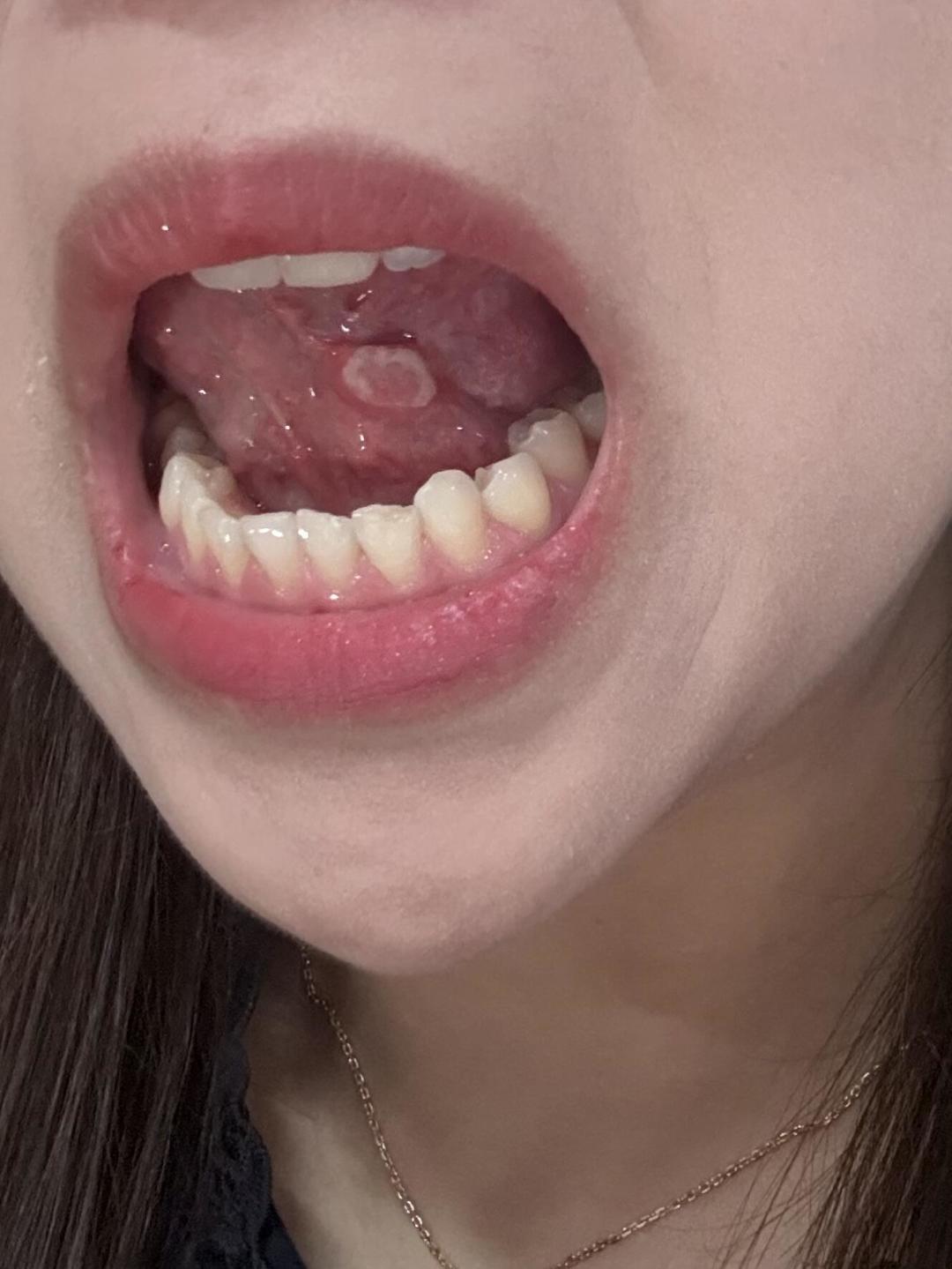 一个月准时报到一次的口腔溃疡:撒盐、清火、39元