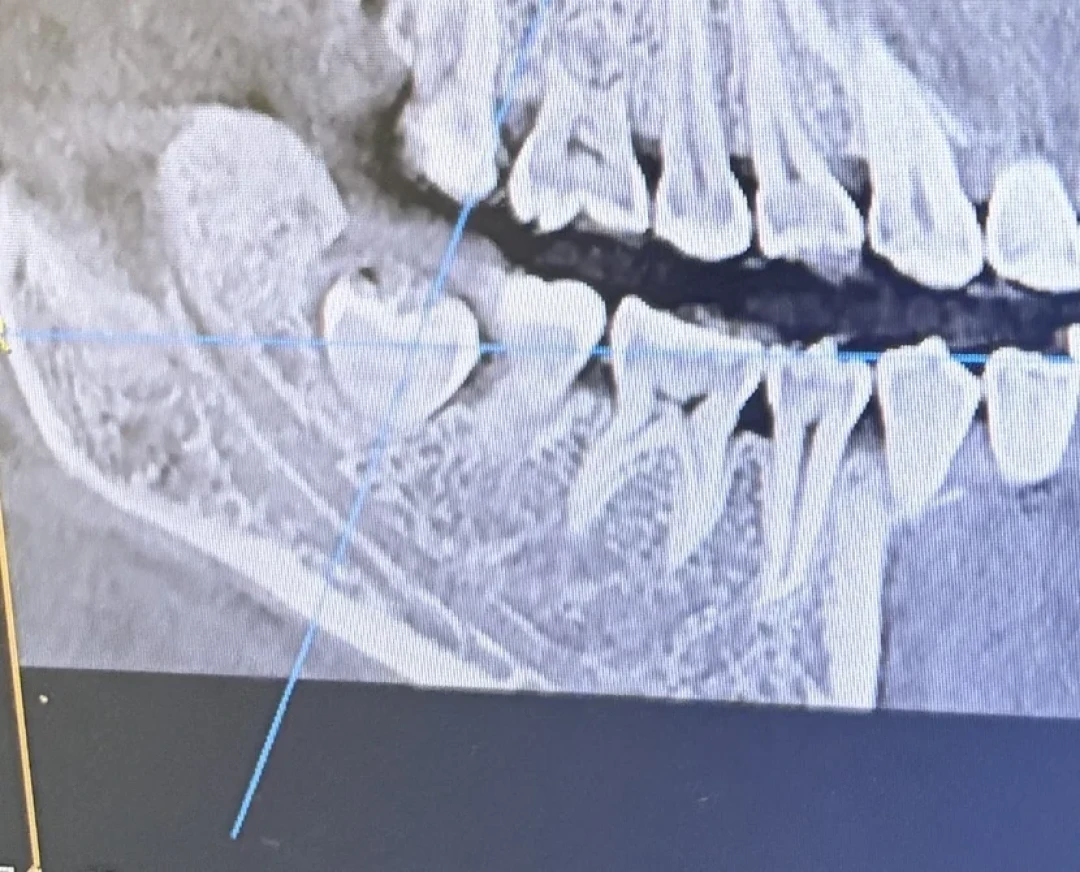 拔智齿到底该花多少钱：今年起公立医院换了套计费方式，我把十几份真实账单、医保口径和刷屏的