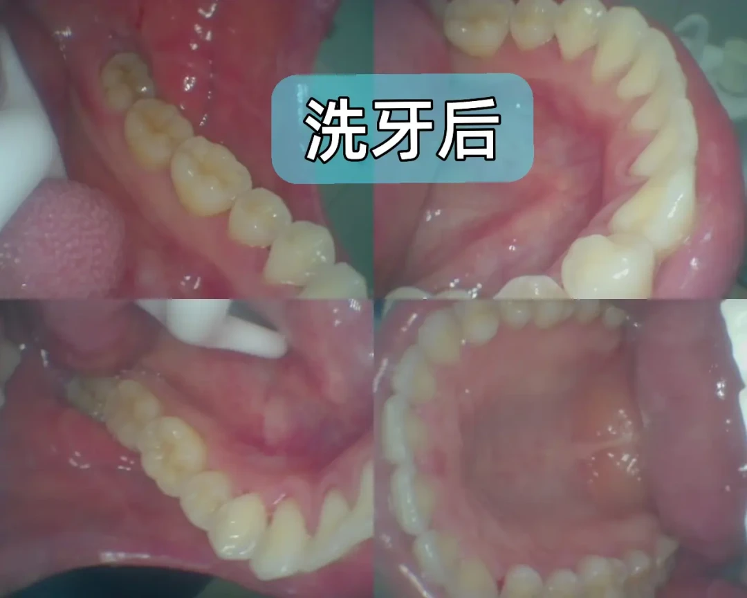 爱牙日就是9·20:洗牙是