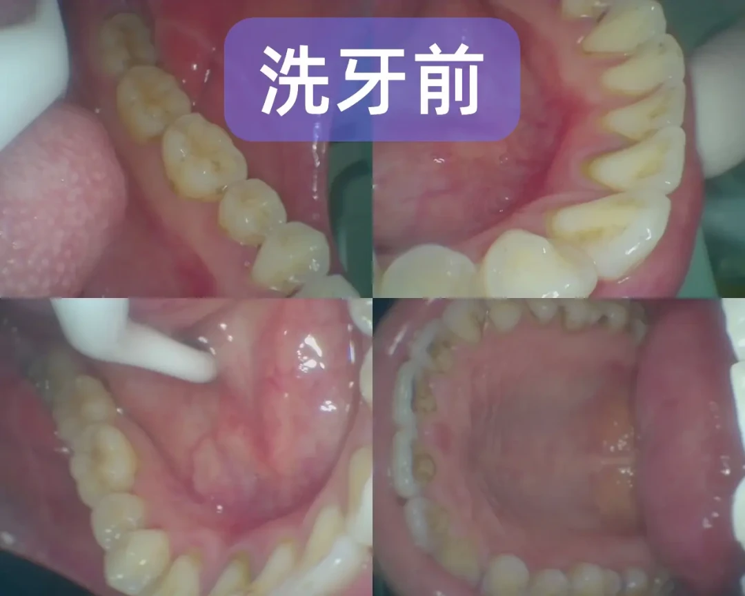爱牙日就是9·20:洗牙是