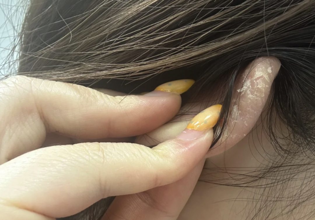 耳垂是享福的命？先别乐，它可能是你全脸最没人管的一块皮