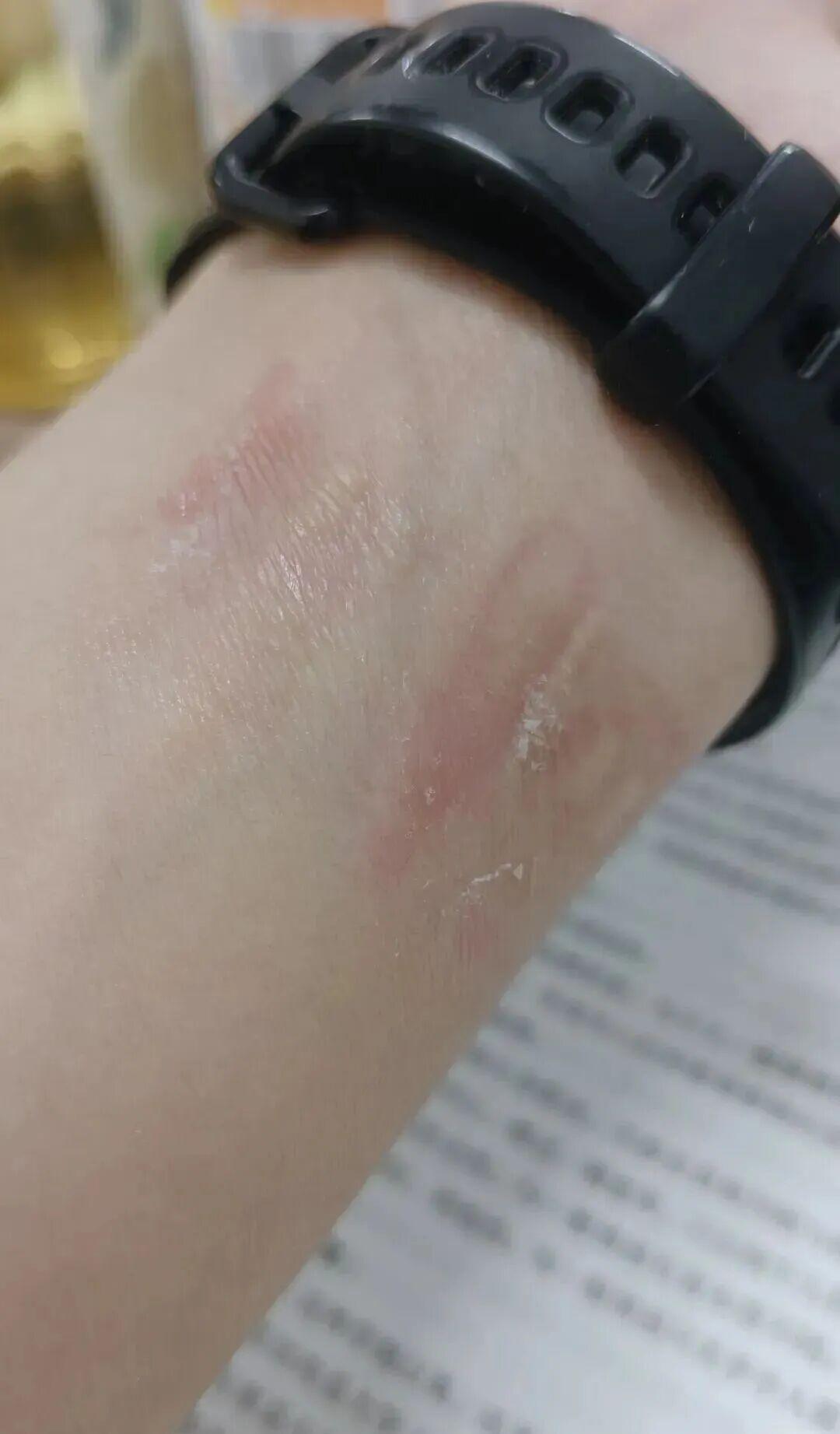 「第一批戴运动手环的受害者」热搜:绿光说被辟谣,78%的手表皮炎是闷汗闷出来的——换表带还是看医生前,先做三步手腕自查