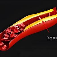 不是高血压也会脑出血！医生点名五类高危人群，第一个很多人都有