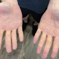 纯肉8个月长出黄色瘤：这一个来月排队去抽血的纯肉党，先把化验单上这几行看懂