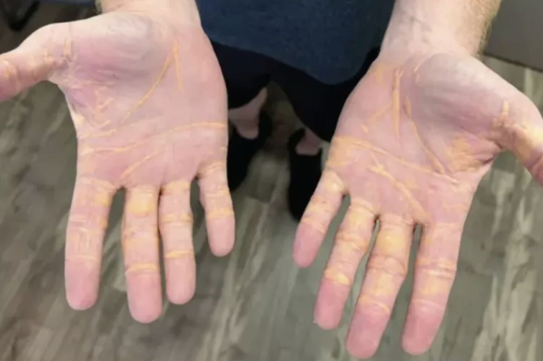 纯肉8个月长出黄色瘤:这一个来月排队去抽血的纯肉党,先把化验单上这几行看懂
