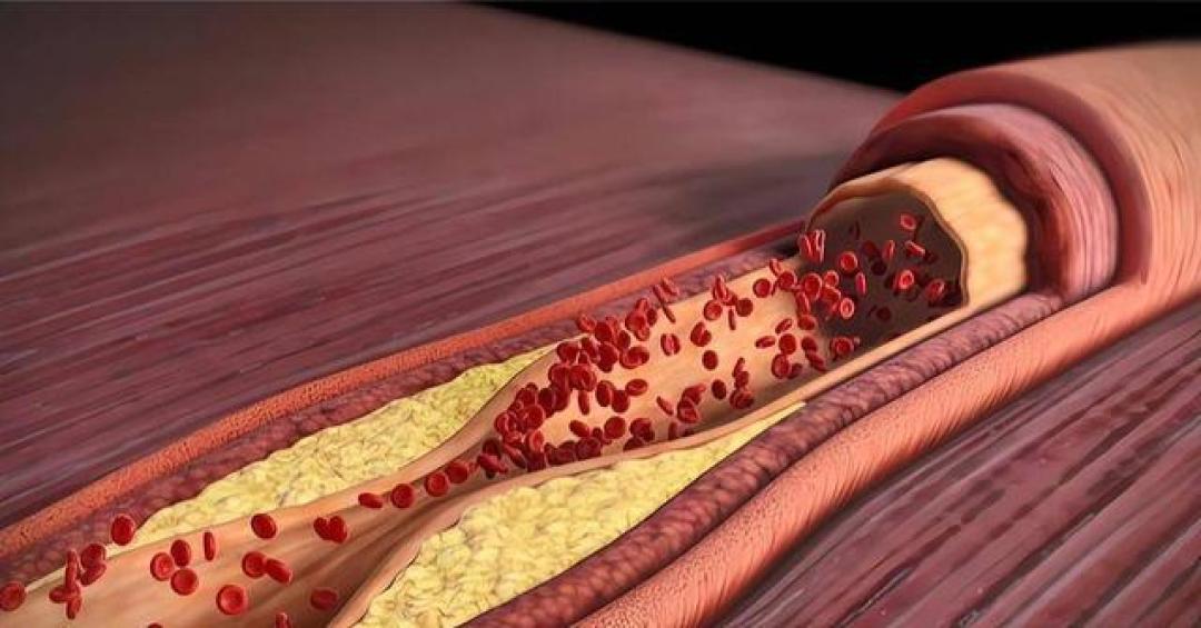 二三十岁血管就堵了？揭秘年轻人血管提前生锈的幕后推手