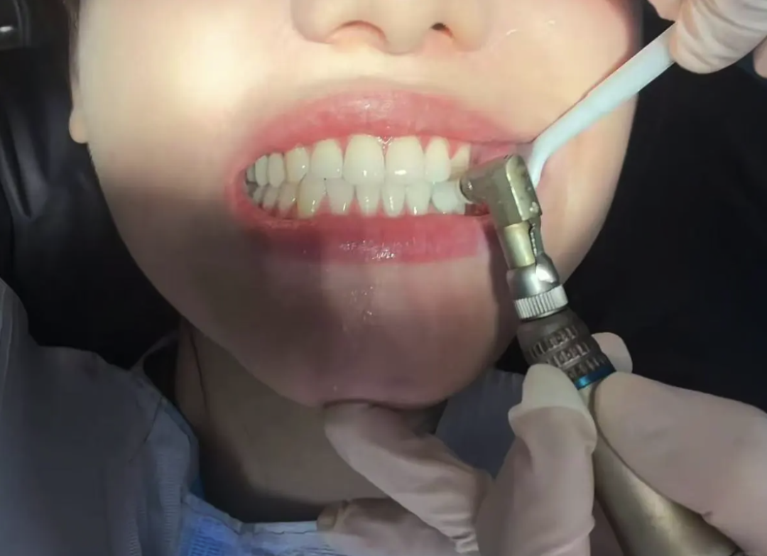 牙齿看着好好的,为什么还是蛀了?这些地方,正在偷偷烂掉