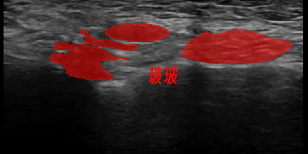 热搜第四个月又轮到「馒化」:打过填充的脸,先查清