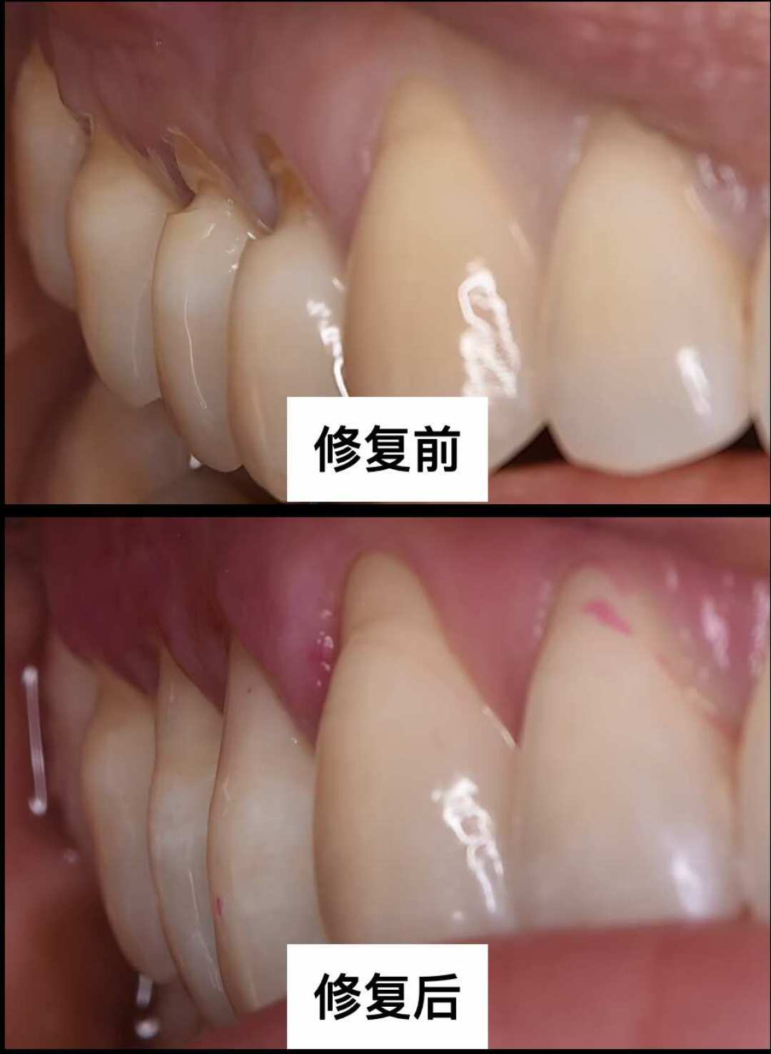 牙根被刷出一条沟,补一颗150也补过6000:医生两种相反的说法其实都对,先看清深度再掏钱