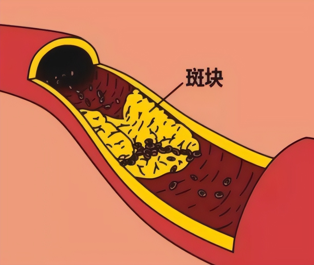 49岁的陈建州血管堵了90%,一个天天打球的人,怎么就心梗了?