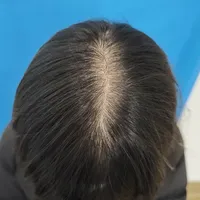 这个月掉的头发，其实几个月前就"预订"了：秋季掉发自查与花钱红线