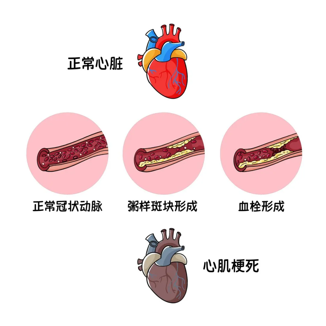 不抽烟、不喝酒、常年运动,血管却完全堵了:陈建州这48小时,每一步都像在给普通人排雷