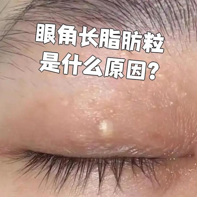 冷知识：眼周脂肪粒和眼霜关系不大，原因你想不到