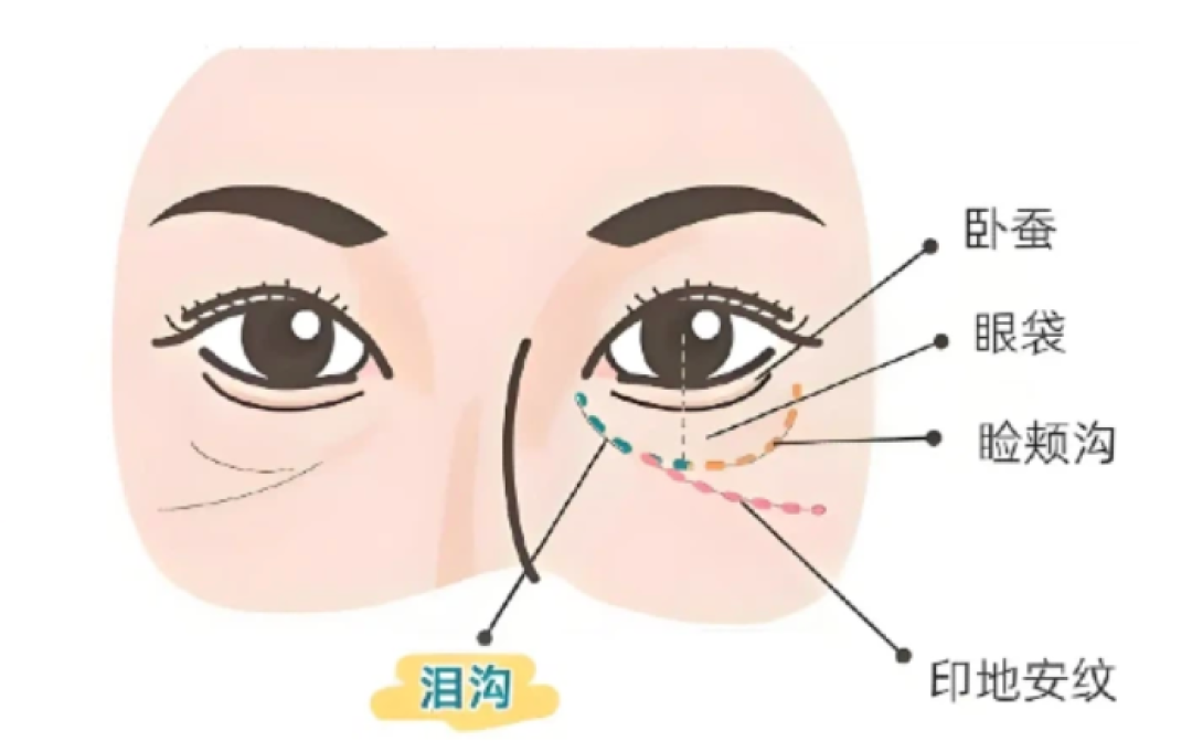 46岁切眼袋花了几万块，这效果值不值？
