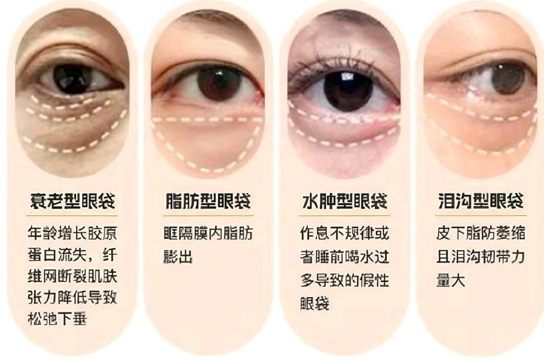 46岁切眼袋花了几万块，这效果值不值？