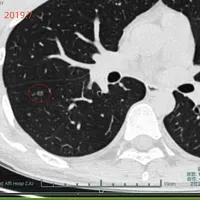 71%肺结节患者从不吸烟？钟南山团队研究刷屏后，不吸烟的人体检加做CT前，先弄清三件事