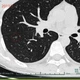 71%肺结节患者从不吸烟？钟南山团队研究刷屏后，不吸烟的人体检加做CT前，先弄清三件事