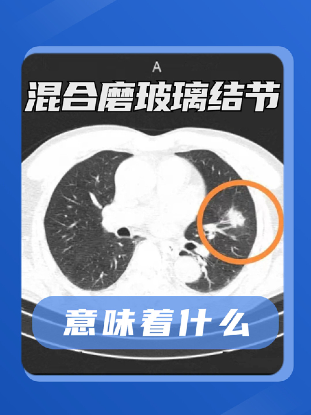 71%肺结节患者从不吸烟?钟南山团队研究刷屏后,不吸烟的人体检加做CT前,先弄清三件事