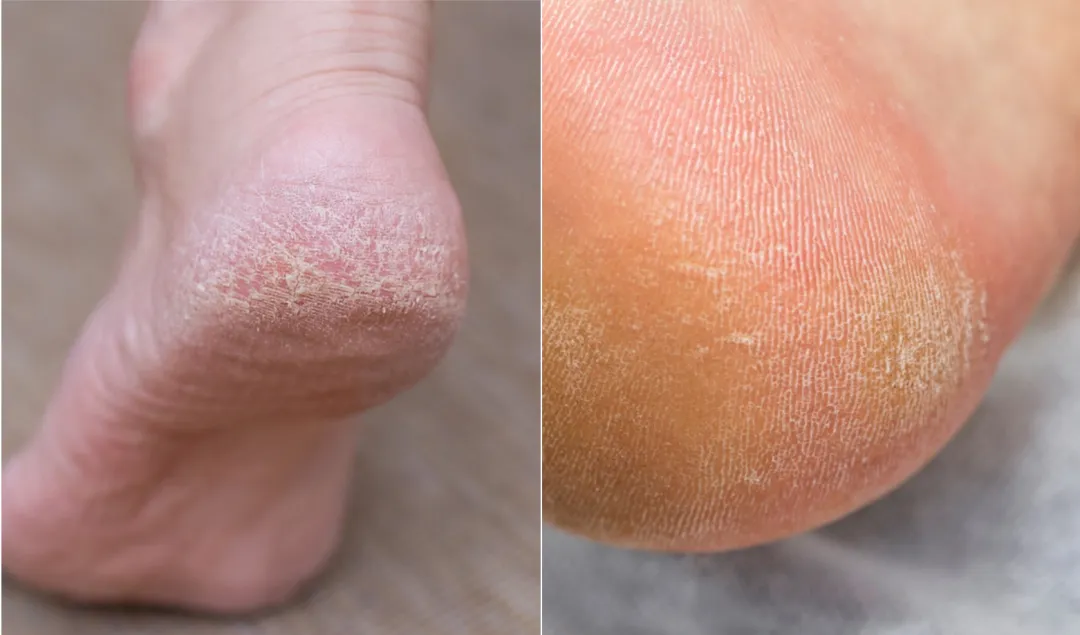 脚后跟干裂总不好?不是保湿不到位,可能是这种皮肤病