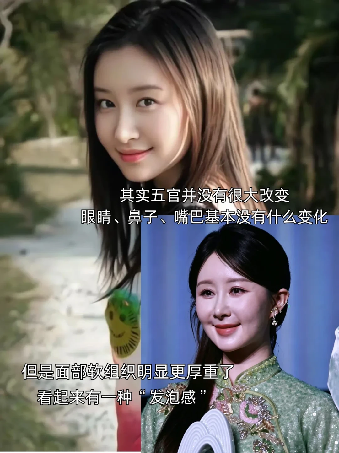 “舒畅脸肿”的猜测吵出432条评论，这周医生开始用FOS说事：打过填充的，先把类型、部位、退路三本账对完